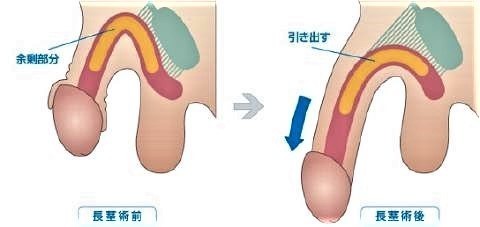 pict-「長茎術」.jpg