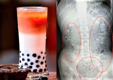 pict-タピオカの飲み過ぎで病院14歳の少女.jpg