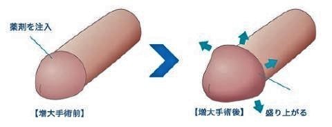 pict-ヒアルロン酸注入治療.jpg